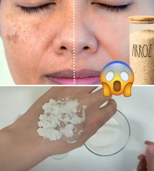 Arroz para Combater Manchas, Incluindo Melasma